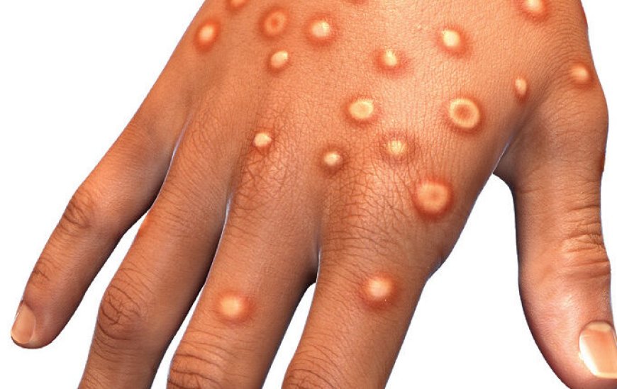 What is Monkeypox ? It's Symptoms, Causes, and Prevention Tips of mpox ?